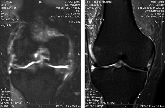 Коленный сустав на низкопольном и высокопольном томографах