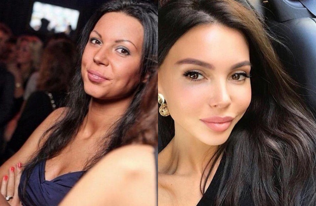 Ольга Бузова: фото до и после пластики