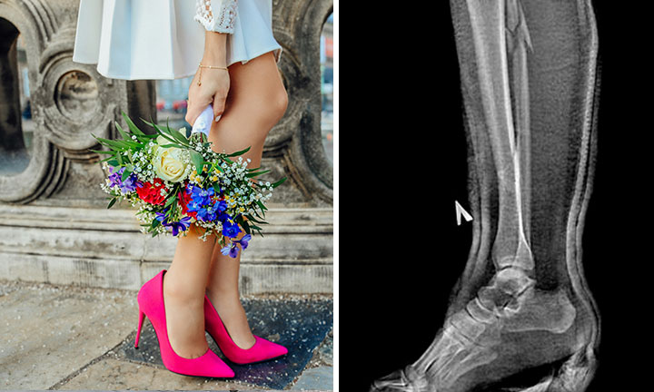 Женщина сломала ногу в трех местах из-за туфель на каблуке