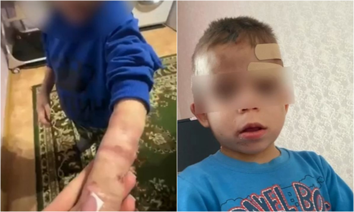 Шестилетнего ребенка избивала мать, потому что он много падал: мальчик в больнице с истощением