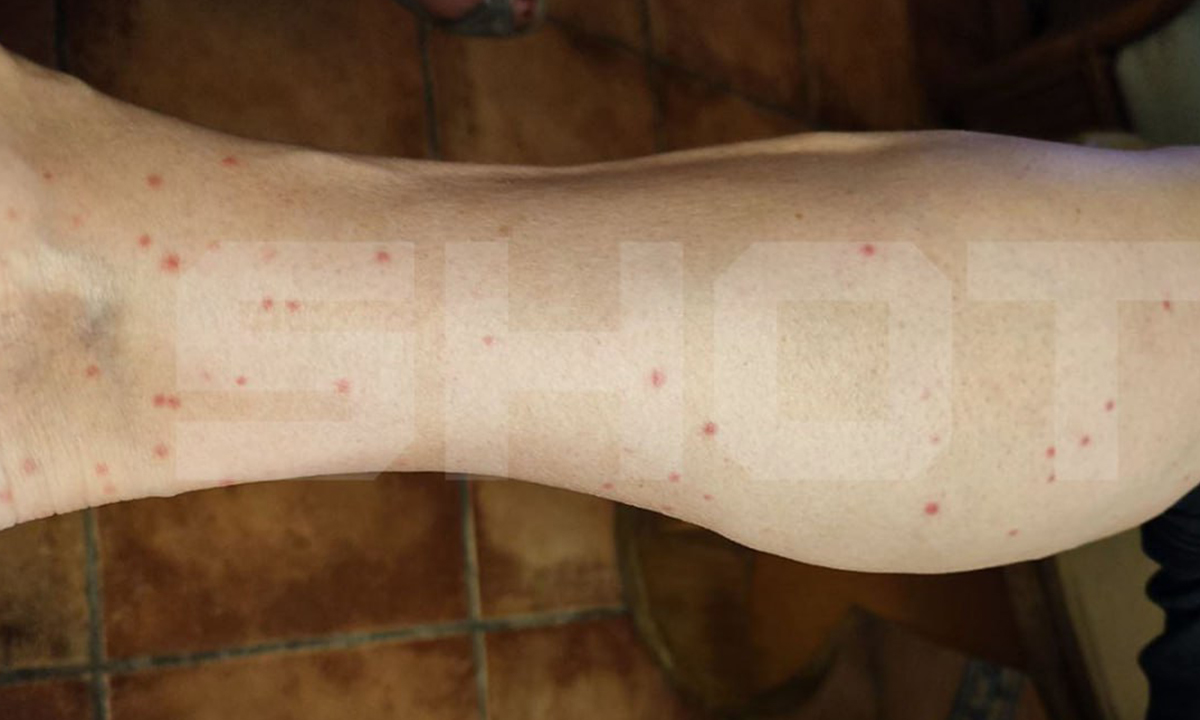 На популярных курортах нашествие клопов