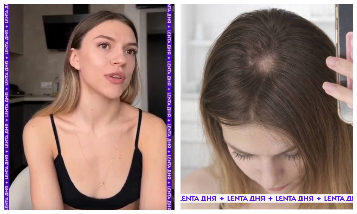 «Мне безумно страшно». Девушка померила шапку с маркетплейса и начала лысеть