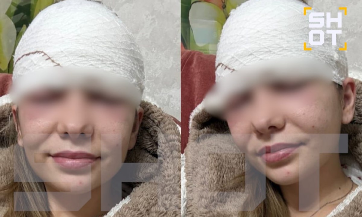 Девушка попала в больнице после того, как выдавила прыщ на лбу