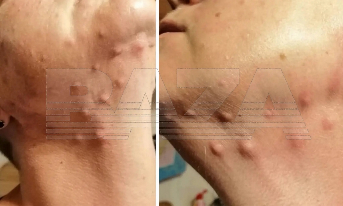 Женщина обколола лицо золотом, пытаясь омолодиться, и попала на стол хирургов