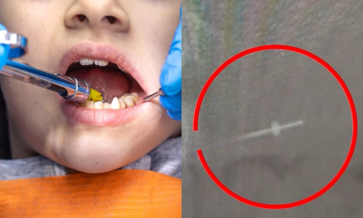 Заведено уголовное дело после того, как 9-летняя девочка проглотила иглу во время лечения зубов в Петрозаводске