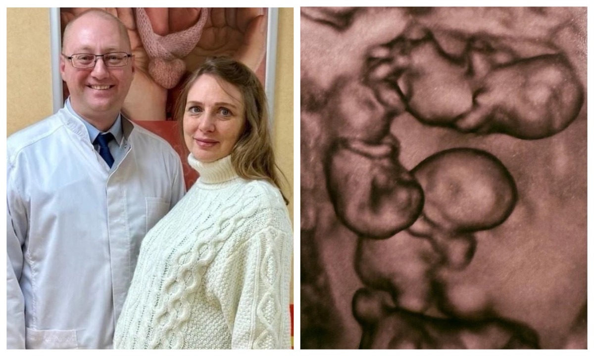 «Один раз на 15,5 миллиона родов». Впервые в России родились уникальные близняшки