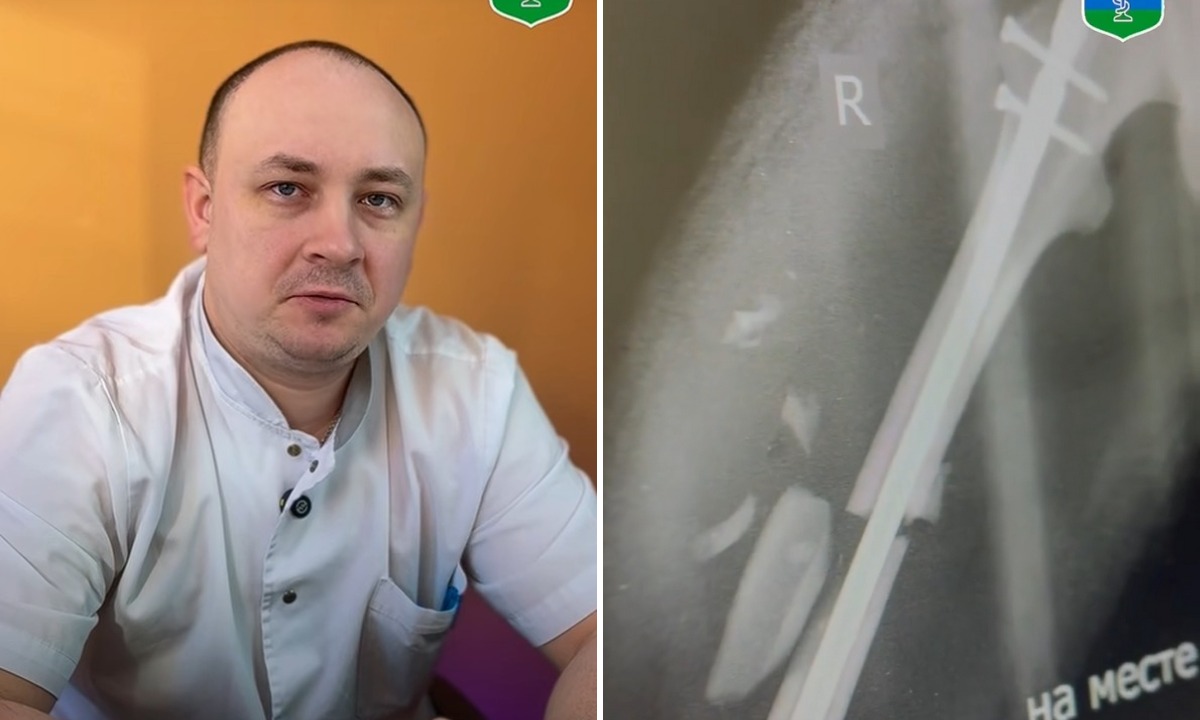 «Почти ежедневно»: в Петрозаводске дети массово попадают в больницу с травмами от питбайков и самокатов