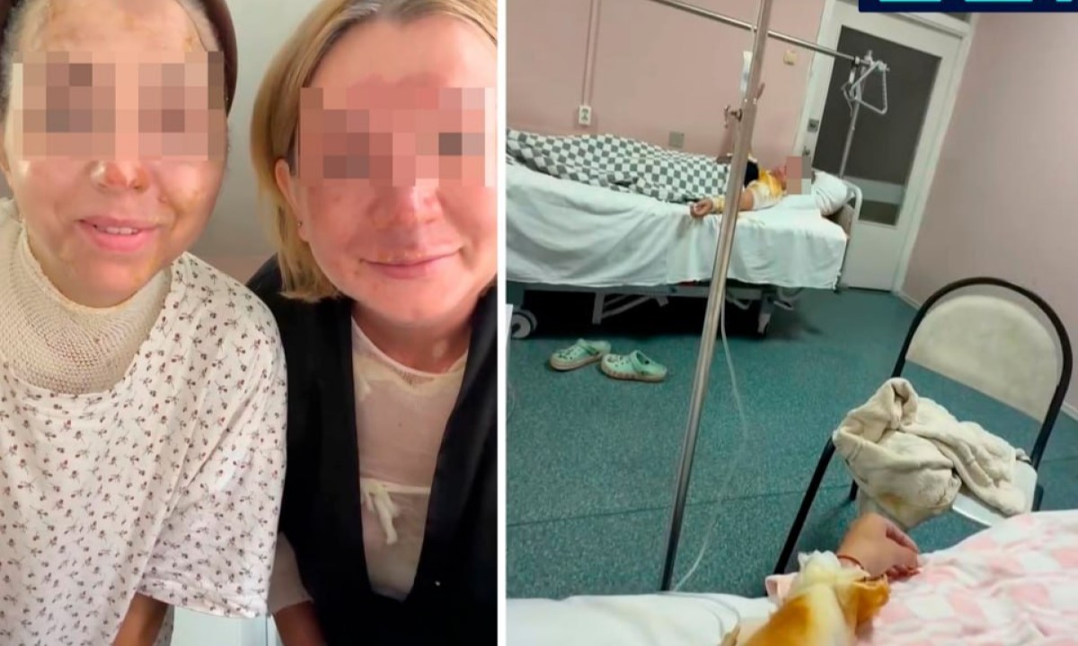 Скороварка взорвалась на кухне: госпитализированы две девушки